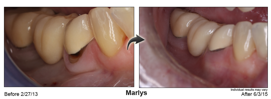 fix receding gums St Paul Minnesota